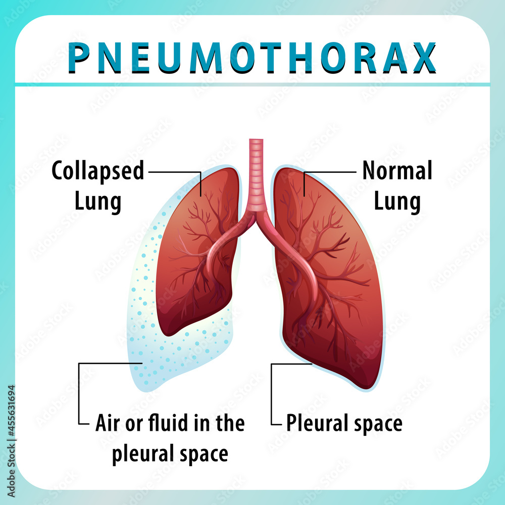 Pneumothorax diagram with collapsed lung and normal lung Pneumothorax diagram with collapsed lung and normal lung