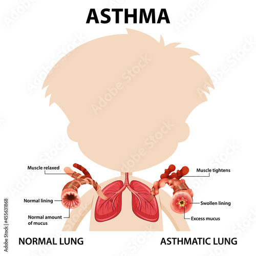 Bronchial Asthma diagram with normal lung and asthmatic lung