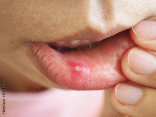 Asian woman showing pain inside her lips. closeup photo, blurred. photo