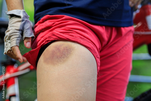 People with bruised leg casused by bike accident