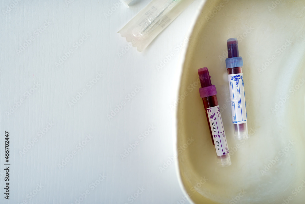 Samples of the patient's blood in closed tubes after collection. Samples of the patient's blood in closed tubes after collection.