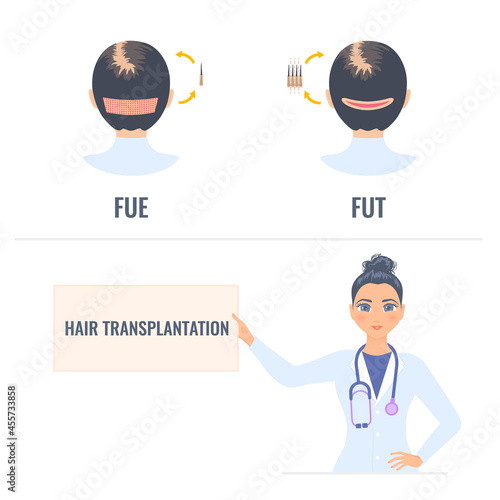 Hair transplantation placard in hands of a woman doctor. FUT and FUE female alopecia treatment infographics. Follicular unit extraction vs follicular unit transplantation. Medical vector illustration.