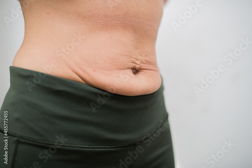 фотографія stretched skin on the abdomen after losing weight
