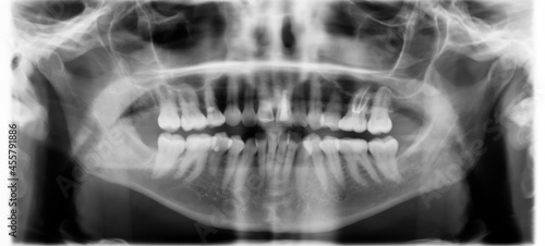 X-ray dental image. photo