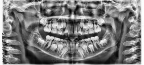 X-ray dental image.