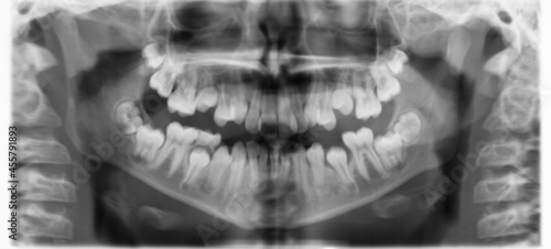 X-ray dental image.