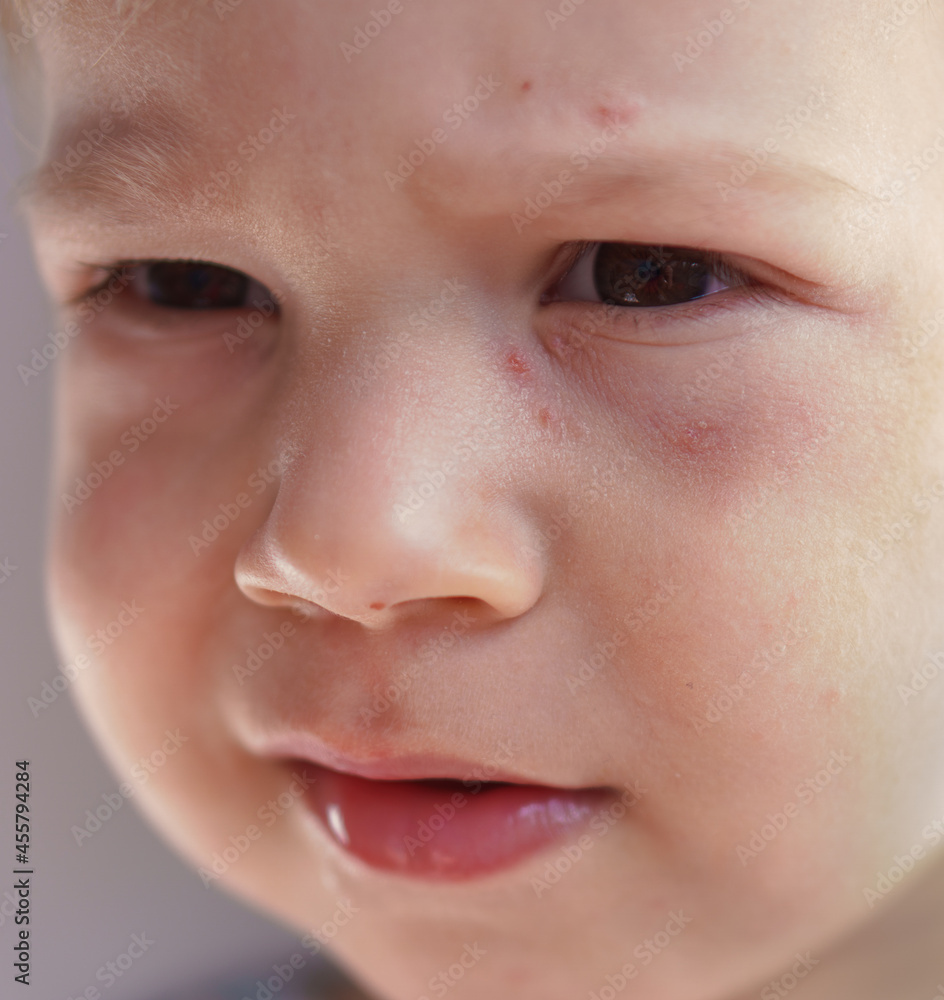 Fototapeta premium Health, dermatology, pediatrics, disease dermatitis concepts - close-up of face small baby child with sick dry skin rash on cheeks. Food allergy flour products, gluten intolerance reduced immunity