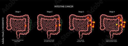 Intestine 3D cancer