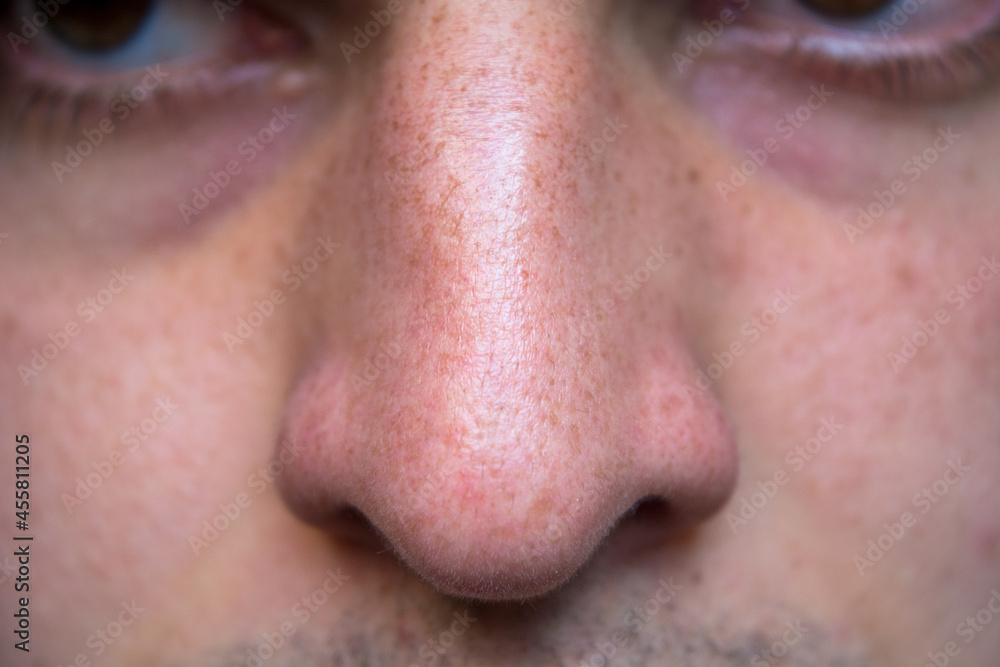 Detail of human nose and nostrils with under eye circles. White skin. Detail of human nose and nostrils with under eye circles. White skin.
