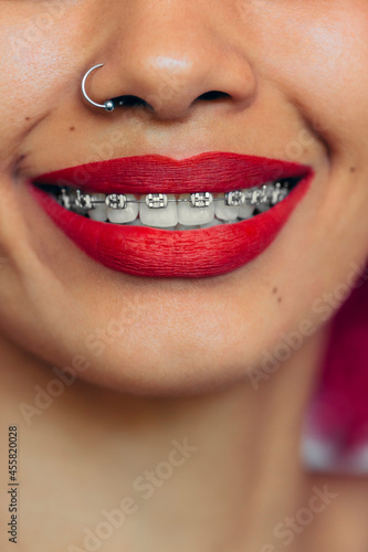 Young woman with braces smiling