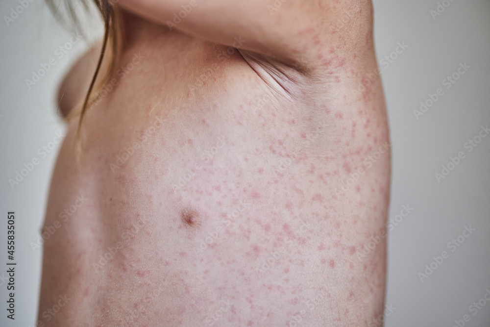 allergic rash on the body of the patient. 5 year old girl. allergic rash on the body of the patient. 5 year old girl.