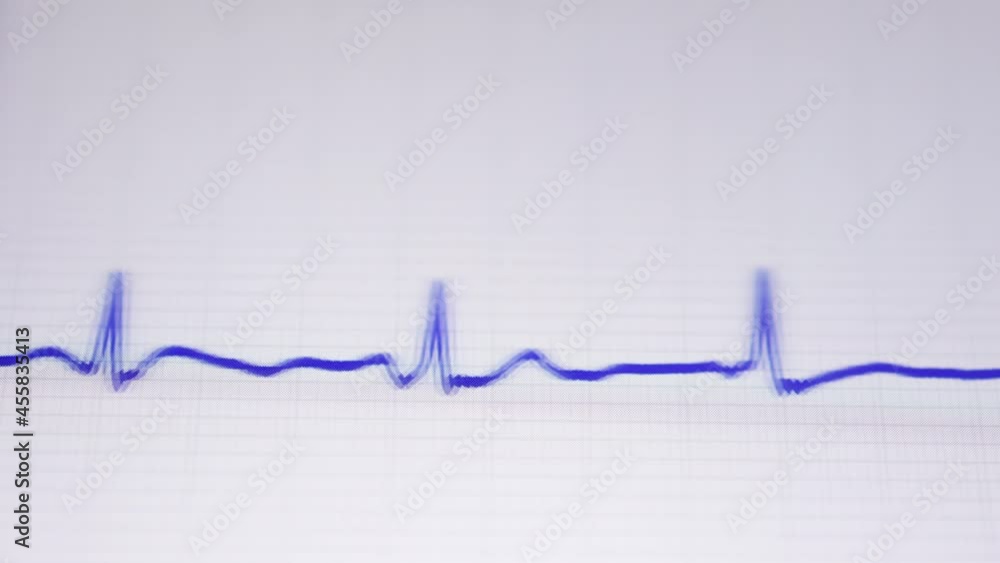 Heart rate electrocardiogram medical monitor Heart rate electrocardiogram medical monitor