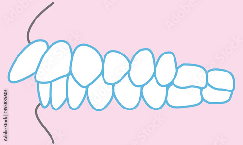 歯並びのイラスト