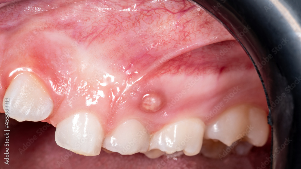 Fistula with pus on the gum in a child.