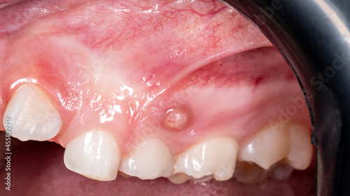 Fistula with pus on the gum in a child. photo