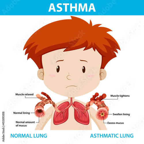 Asthma diagram with normal lung and asthmatic lung