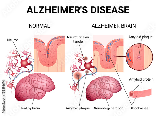Alzheimer disease and changes in the brain