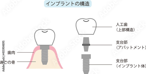 インプラントのイラスト