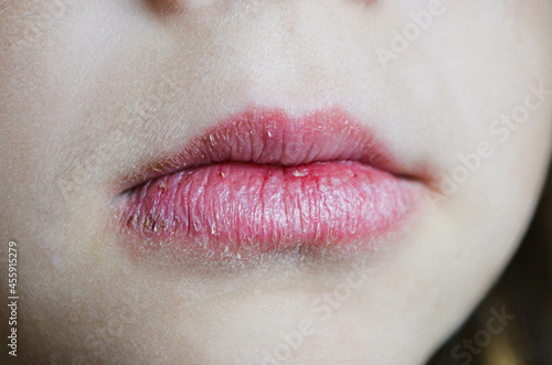 Angular cheilitis close up of chapped, cracked lips caused wound on the corner of the lips: dry skin problem with mouth disease. High quality photo photo