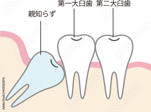 親知らずのイラスト
