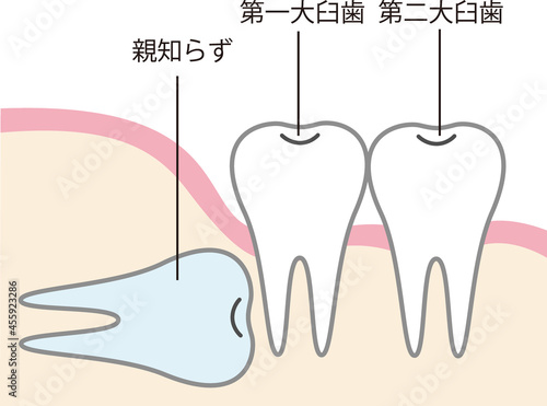 親知らずのイラスト