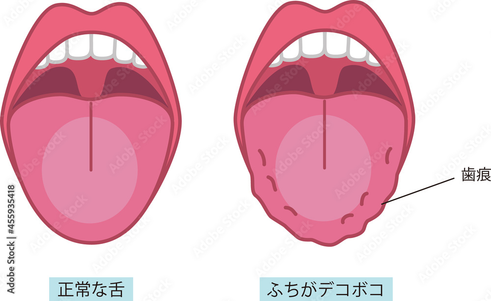 舌の健康についてのイラスト Stock Vector Adobe Stock 舌の健康についてのイラスト Stock Vector Adobe Stock