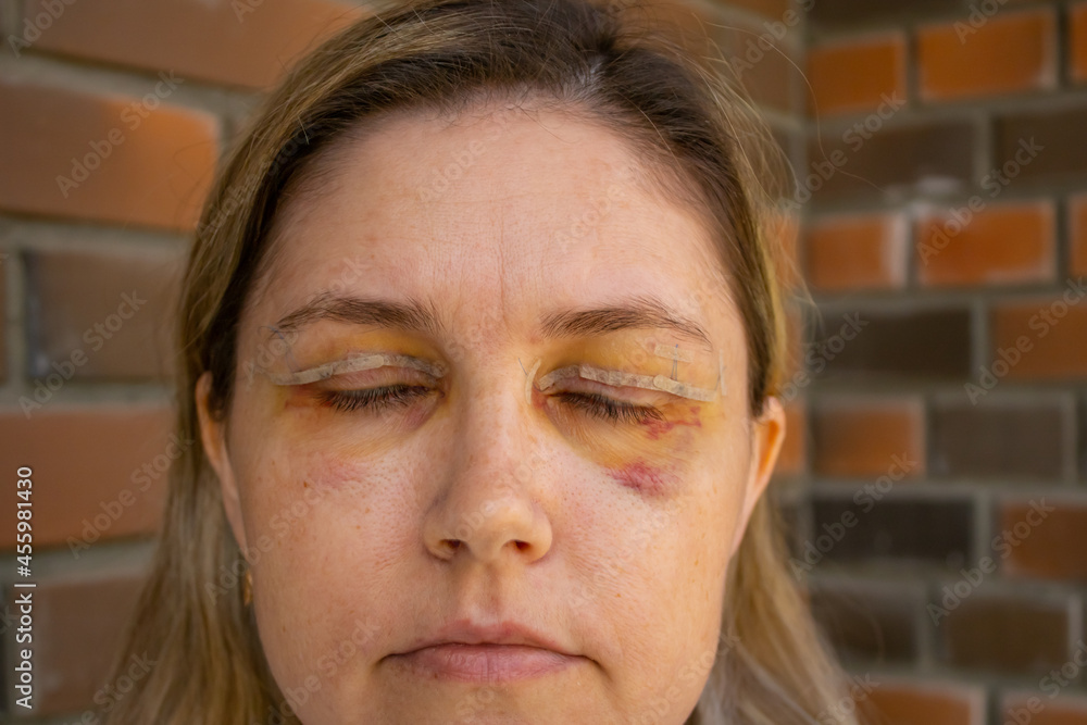 Double Eyelid Surgery, Eyes Surgery Recover Period, immediately after