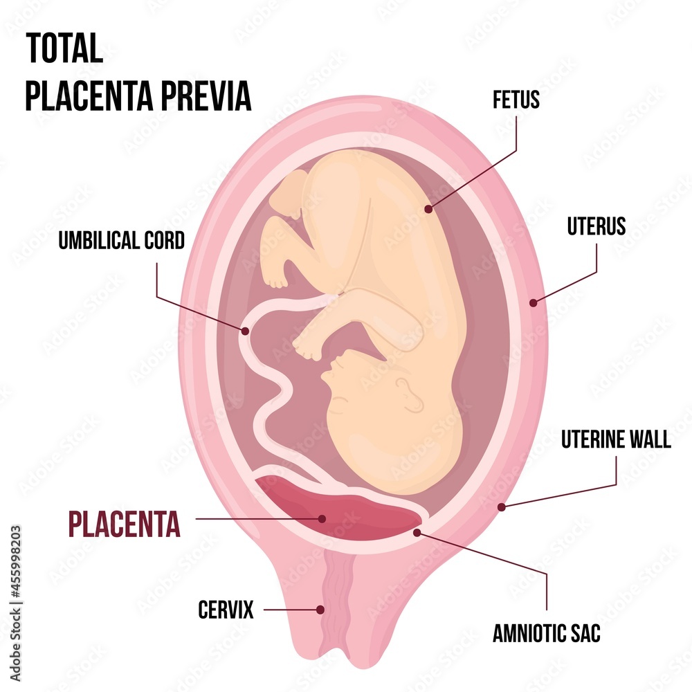 Fototapeta premium Total Placental previa. Dangerous Placenta Location During Pregnancy. Medical Pathology. detailed medical diagram with table of symbols.