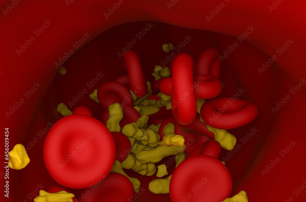 Higher level of cholesterol crystals and red blood cells flowing in ...