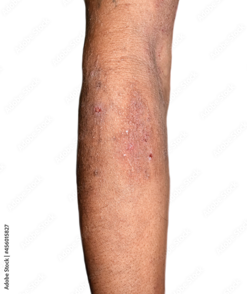 Alcoholic dermatitis due to niacin or vitamin B3 deficiency resulting in pellagra. Rough and dry