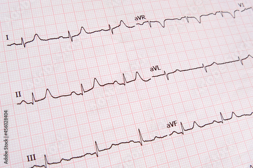 ECG graph recording an elderly patient's heart condition. Graph printout showing the result of an adult person's electrocardiogram (EKG) after medical test. Closeup top view.