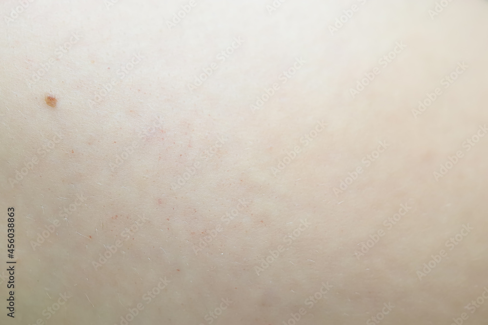 close-up of the skin after using an ultrasound machine to remove cellulite in problem areas close-up of the skin after using an ultrasound machine to remove cellulite in problem areas