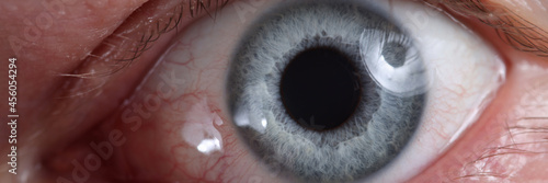 Photos Closeup of diseased eye with red dilated vessels
