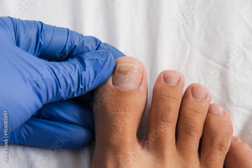 A doctor examines bare foot with onycholysis on a toenail after damaging with tight shoes or using gel-lacquer photo