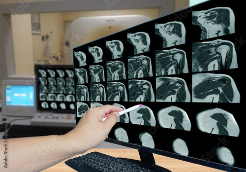 Magnetic resonance imaging of left shoulder rotator cuff tear with suspected lipoma of left shoulder science and education mri shoulder background