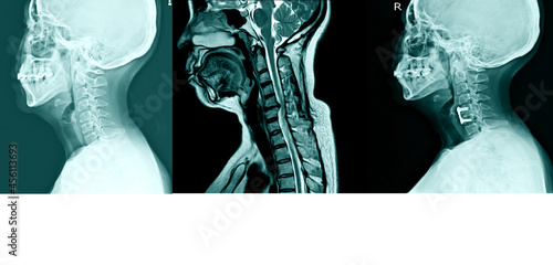 X-ray C- Spines and MRI scan of a patient with chronic upper extremities weakness showing herniated nucleus pulposus at C4-C5 levels Cervical Spine Osteoarthritis,Cervical disc herniation. photo