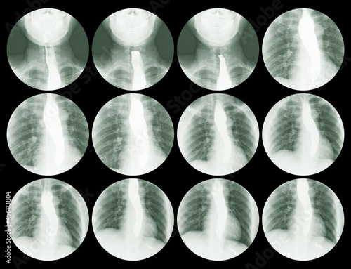 Slika na platnu Collection step swallowing test Esophagogram(Barium Sulfate (BaSO4) ),Medical image concept