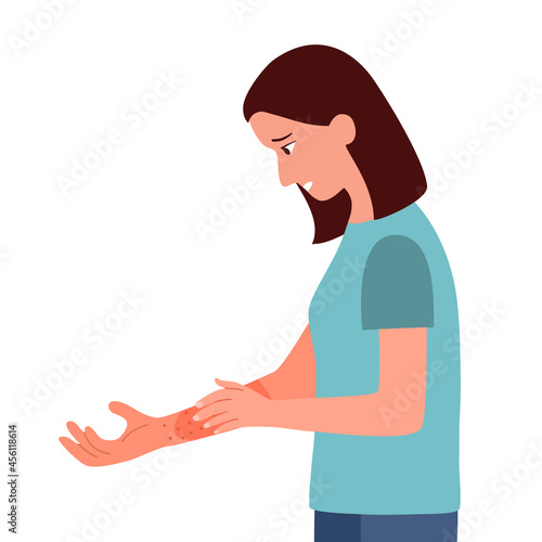 Young woman scratching arm. Female suffering from strong allergy skin itchy symptom in flat design. Red rash skin irritation.