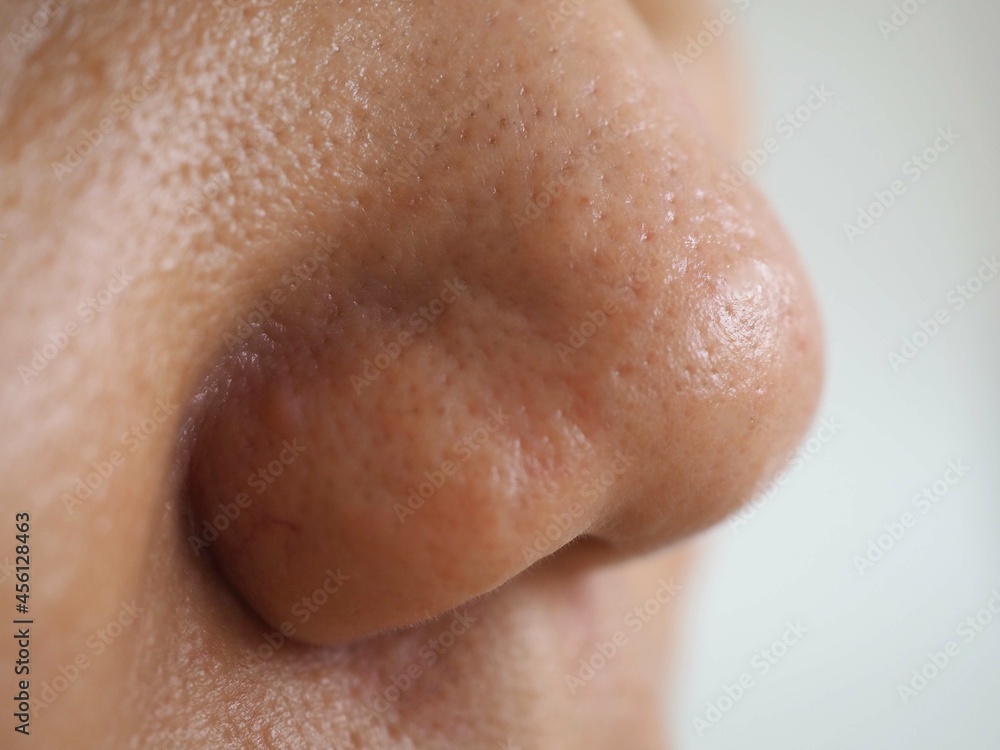 Fototapeta premium Asian woman has skin problem, large pores, whitehead and blackhead pimple. closeup photo, blurred. 