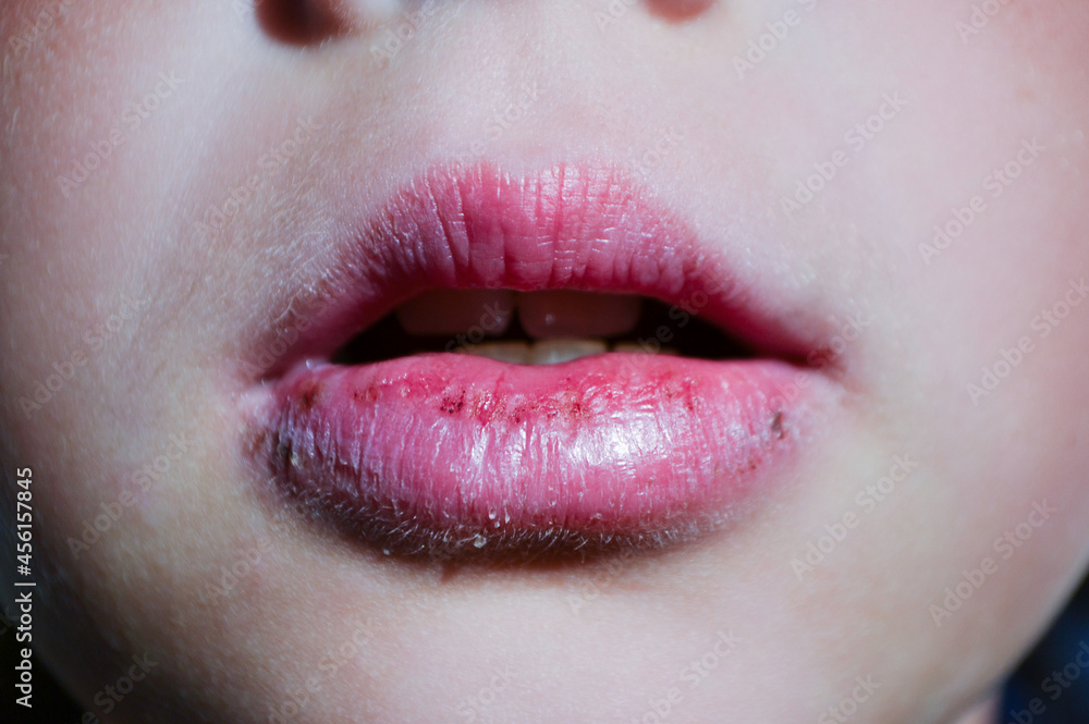 Obraz premium Angular cheilitis close up of chapped, cracked lips caused wound on the corner of the lips: dry skin problem with mouth disease. High quality photo