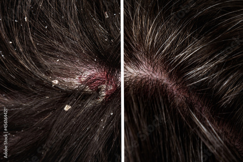 Before and after dandruff treatment shampoo on hair woman. Dandruff in the hair. Flaky scalp. Seborrhea. photo