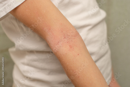 Atopic dermatitis. Eczema