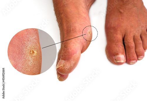 Close up a callus on man's foot. Callus is common foot problem by a toughened skin become relatively thick and hard in response to repeated friction, pressure, or other irritation isolated on white. photo