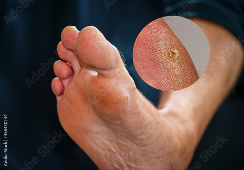 Close up hard skin on man foot. Skin problem foot callus or soft Corn on the side of man's foot. Isolated on black background photo