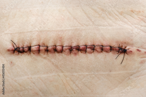 Postoperative suture on human skin