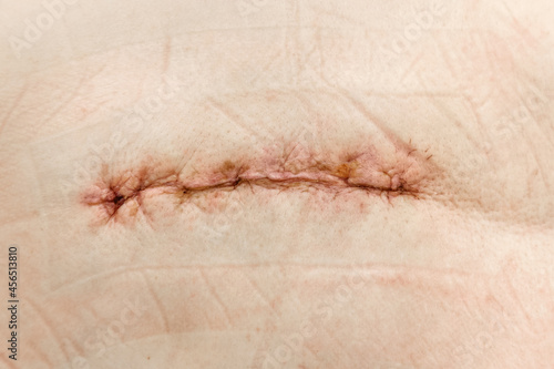 Postoperative suture on human skin
