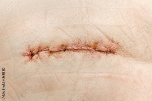 Postoperative suture on human skin
