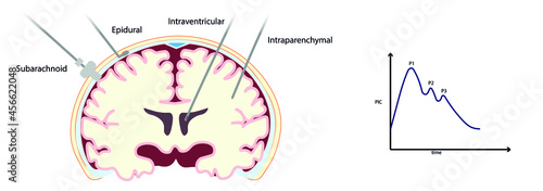 Intracranial Pressure Monitoring (ICP) monitoring device placement in a Coronal section. photo