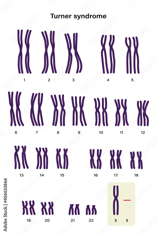 Human karyotype of Turner syndrome. One of the X chromosomes (sex