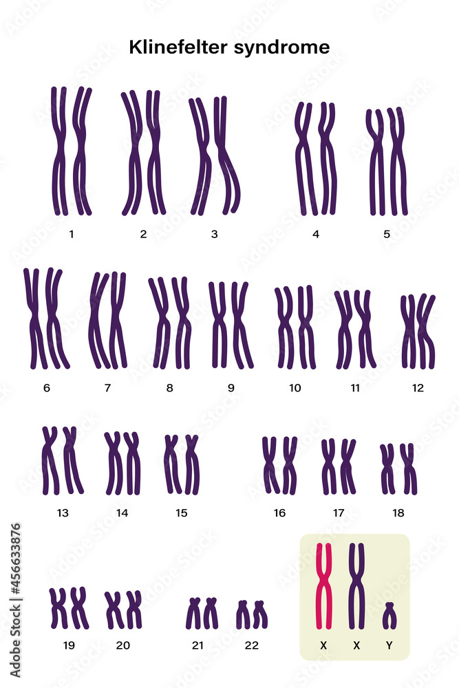 Human karyotype of Klinefelter syndrome. Klinefelter's, KS or XXY